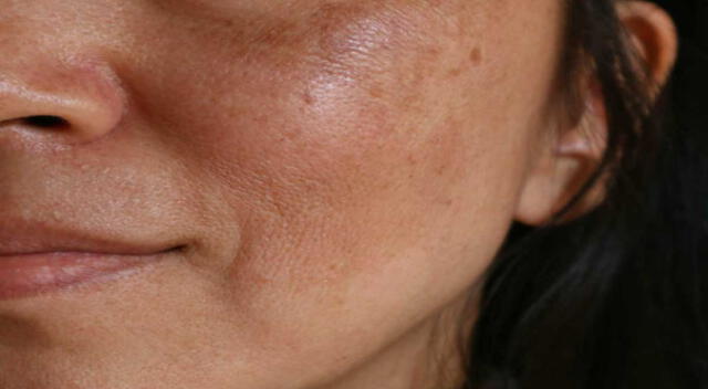 Elimina las manchas en el rostro con solo un ingrediente casero.