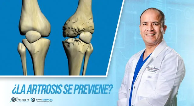¿La artrosis se puede prevenir?