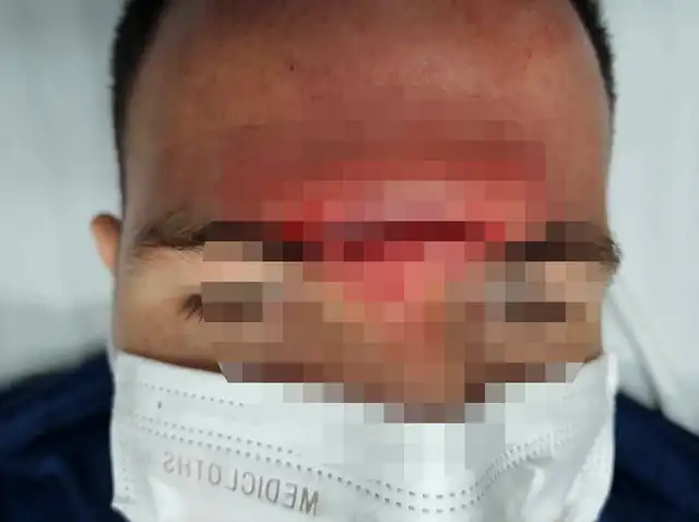 Adrián Ugarriza y el corte en la frente luego del Cienciano vs. Alianza Universidad.   