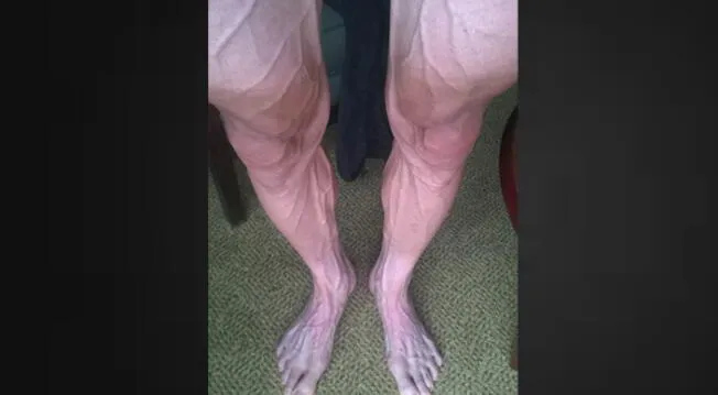 Así quedaron las piernas del polaco Bartosz Huzarski, tras la etapa 18 del Tour de Francia.