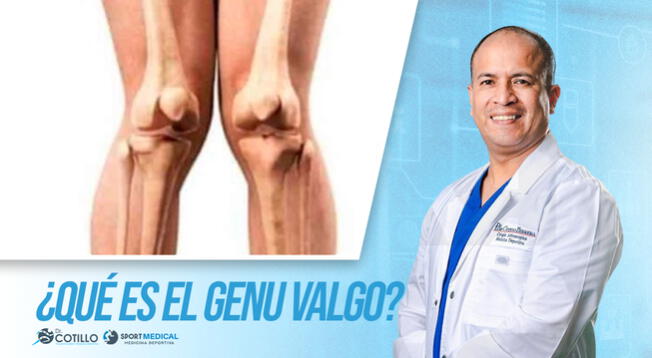 ¿Qué es el genu valgo o valgo de rodilla?, por el Dr. Luis Cotillo
