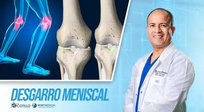 ¿Cómo sé que tengo un desgarro meniscal?, por el Dr. Cotillo ¿Cómo sé que tengo un desgarro meniscal?, por el Dr. Cotillo