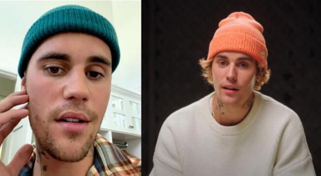 Justin Bieber: ¿qué es el síndrome de Ramsay Hunt?, actual padecimiento del joven cantante