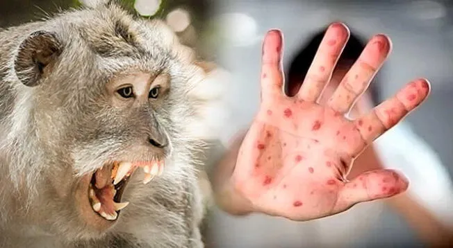 Viruela del Mono en Perú: Suben a 56 el número de casos confirmados