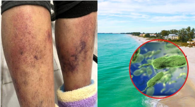 Peligrosa y mortal bacteria se hace presente en las aguas de Florida. Peligrosa y mortal bacteria se hace presente en las aguas de Florida.