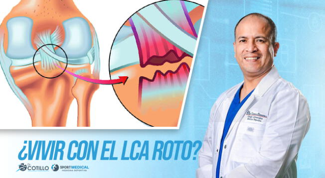 ¿Se puede vivir con el Ligamento Cruzado Anterior (LCA) roto?