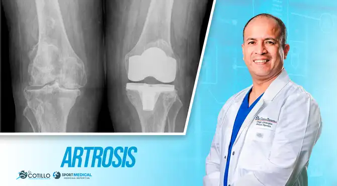 Artrosis Luis Cotillo