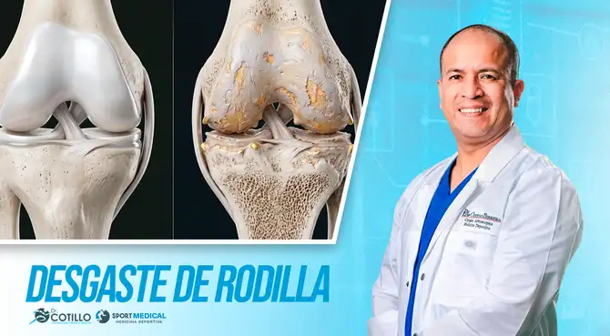 Desgaste de rodilla, según el Dr Luis Cotillo
