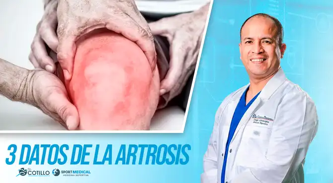 Datos clave de la artrosis